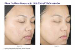 Sistem complet antiaging impotriva hiperpigmentarii Obagi NuDerm  Skin Transformation System - NORMAL TO OIL 7 Produse