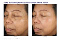 Sistem complet antiaging impotriva hiperpigmentarii Obagi NuDerm  Skin Transformation System - NORMAL TO OIL 7 Produse