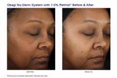 Sistem complet antiaging impotriva hiperpigmentarii Obagi Nu-Derm  Skin Transformation System - NORMAL TO DRY 7 Produse